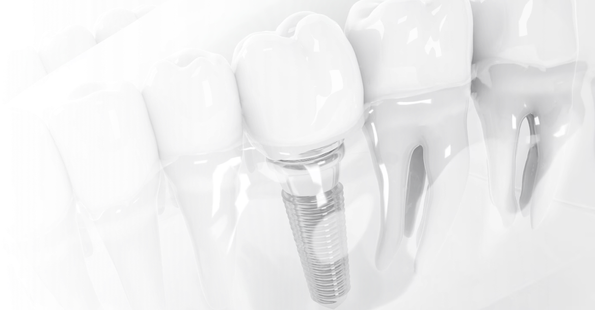 骨とインプラントが結合する期間