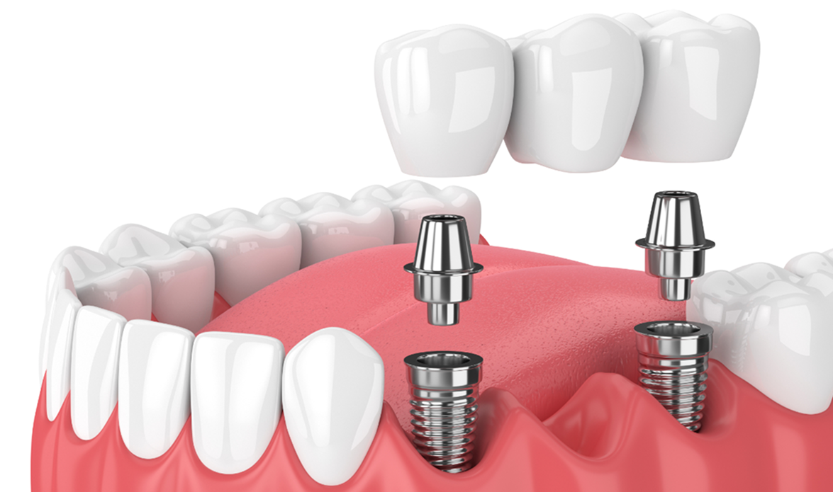 見た目や噛み心地が、天然の歯に近い治療法